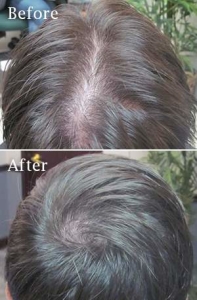 Laser Hair Retention Therapy Orlando Fl- HCI Hair Solutions