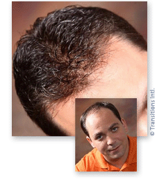 male-hair-loss-replacement